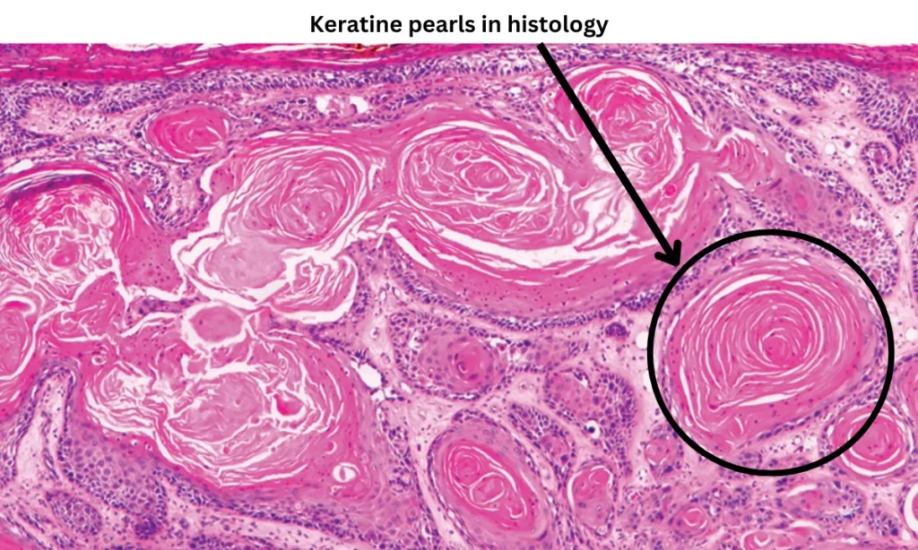 histology of squamous cell carcinoma.