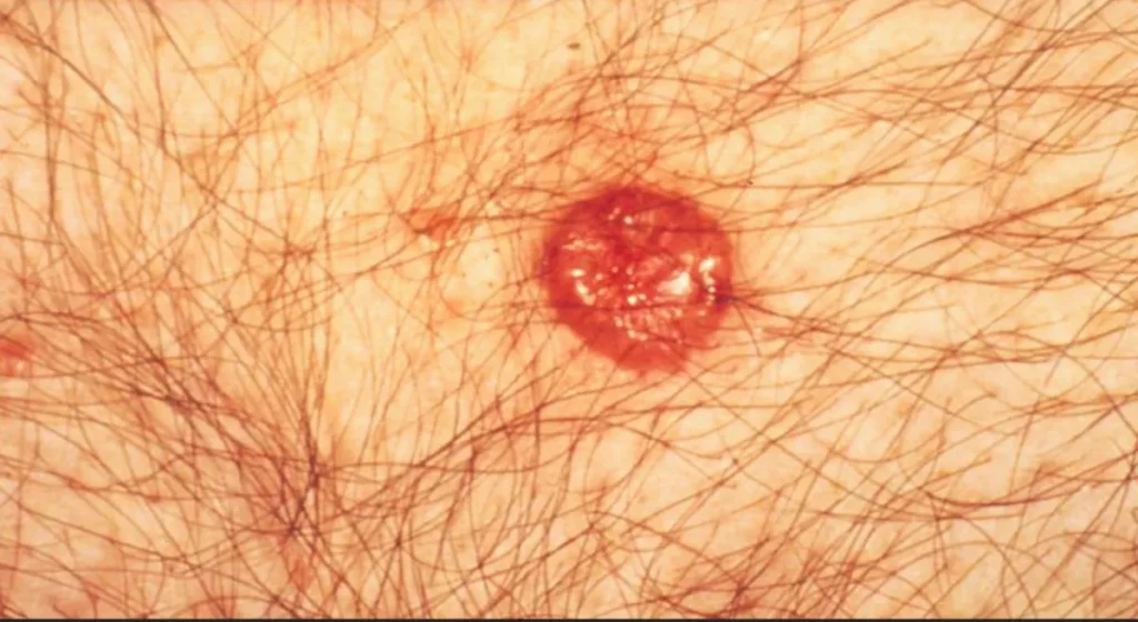 basal cell carcinoma images