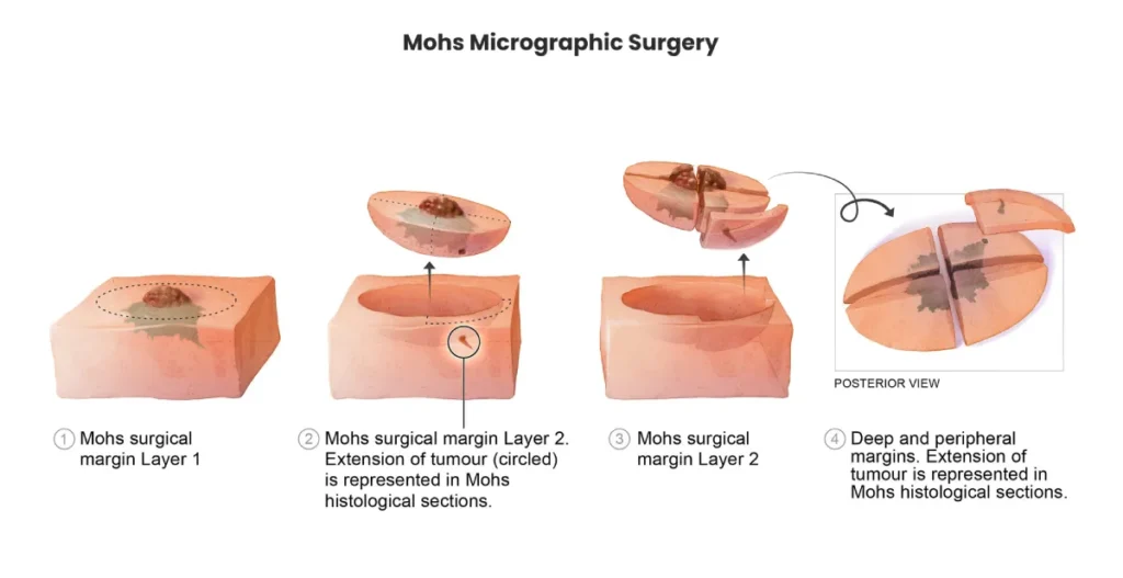 mohs micrographic surgery